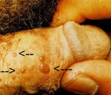 Erkekte HPV Resimleri, Kondilom Genital Siğil Fotoğrafları