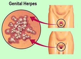 Nasıl testi yapılır herpes genital Genital Uçuk