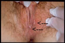 Kadında HPV Resimleri, Kondilom Genital Siğil Görüntüleri